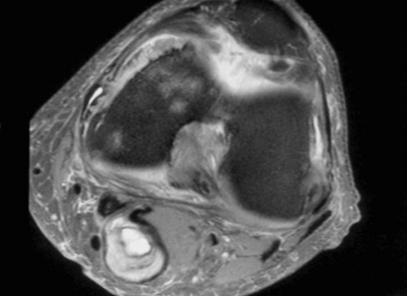 Bakers Cyst MRI Axial